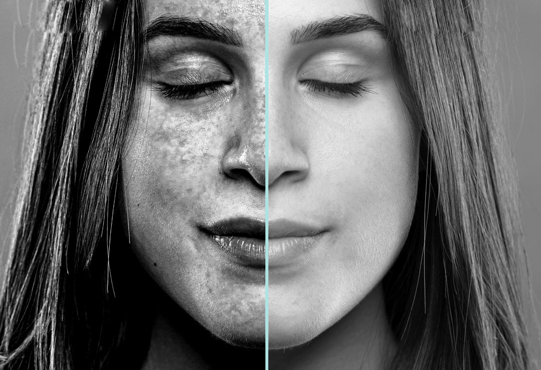 5 Things You Need to Know About Hyperpigmentation Repêchage®