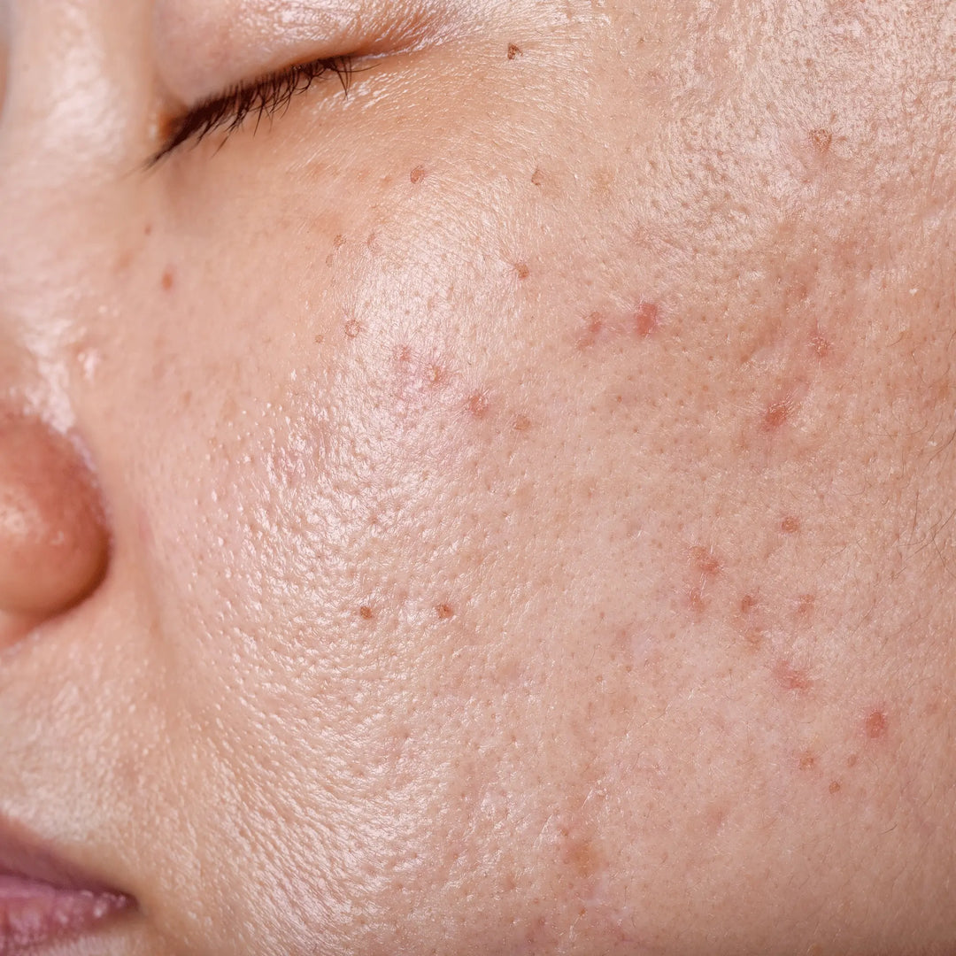 5 Do’s and Don’ts for Oily and Problem Skin Repêchage®