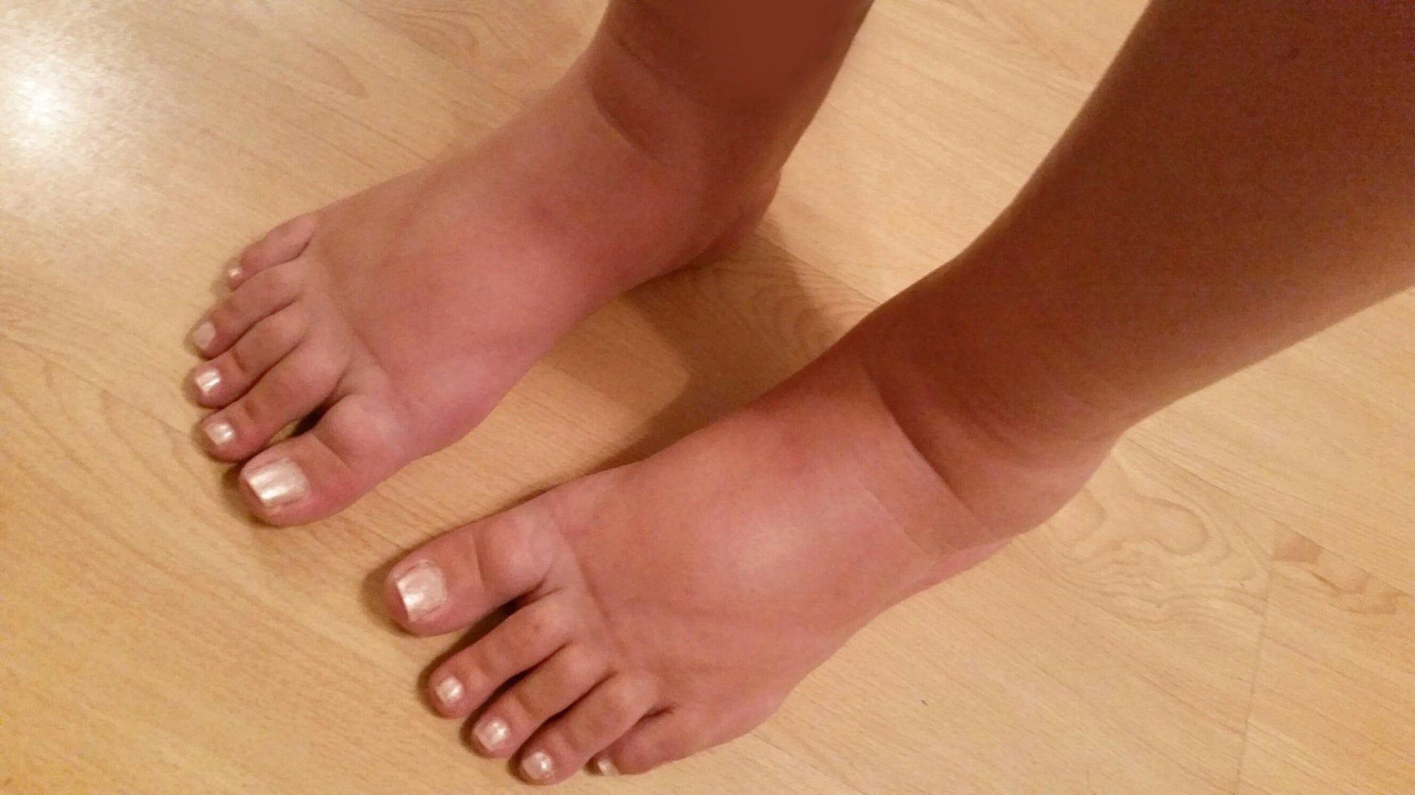 How to Relieve Swollen Feet and Ankles When Pregnant